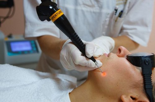 Удаление бородавок лазером