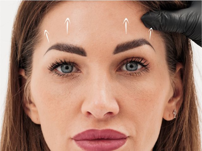 Лифтинг лба