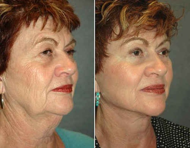 Плазмолифтинг отзывы фото до и после лицо